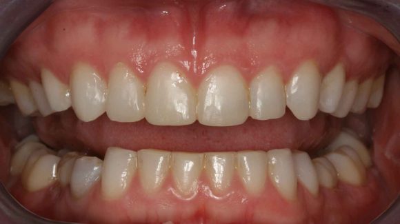 uneven-teeth-edges