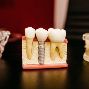 dental-implants-farnham-model