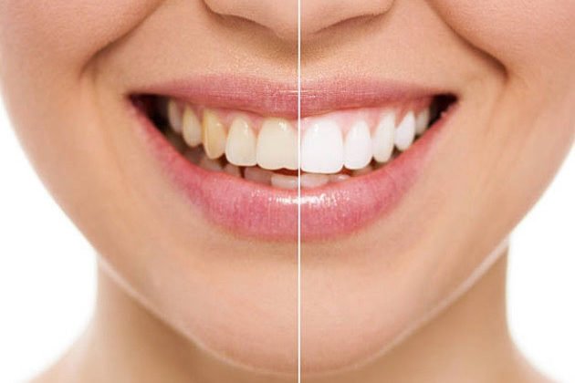 Cosmetic Bonding and Composite Dental Bonding