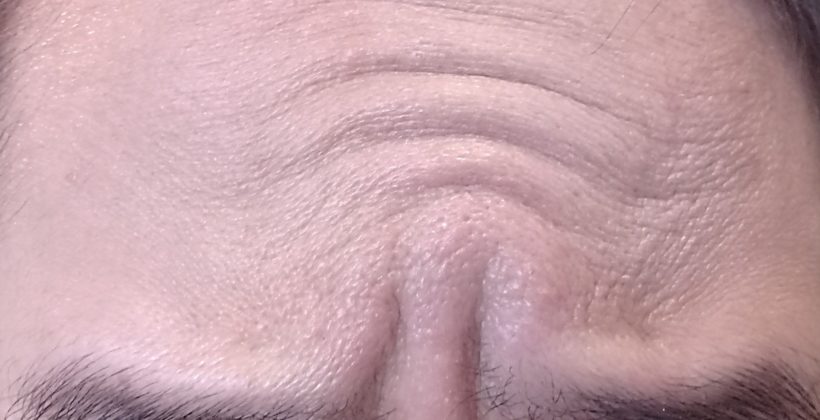 Wrinkle Reduction in Camberley & Godalming
